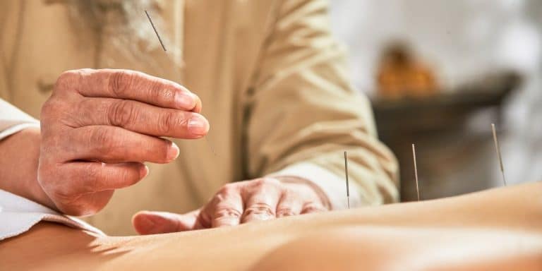 woman placing acupuncture needles on someones back